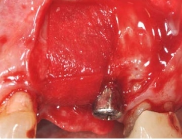 InterCollagen Guide placement