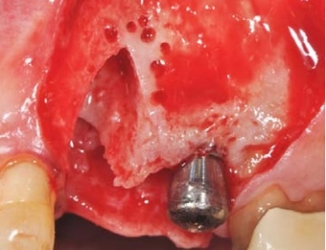 Placement of implant via crestal sinus lift