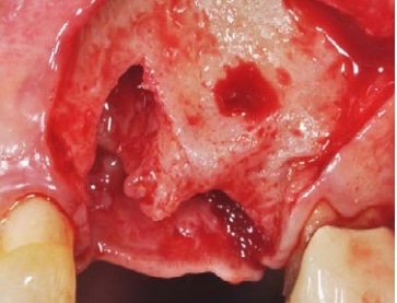 A view of the bone defect