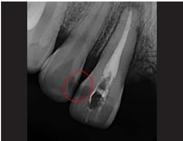 Pre-operative X-ray