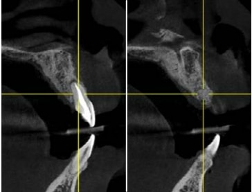 Pre-operative CBCT