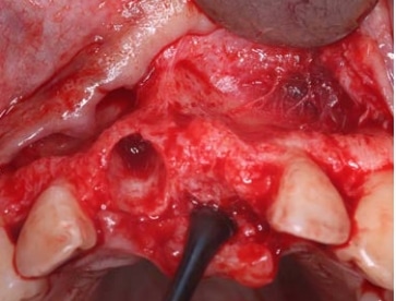 Post-extraction view