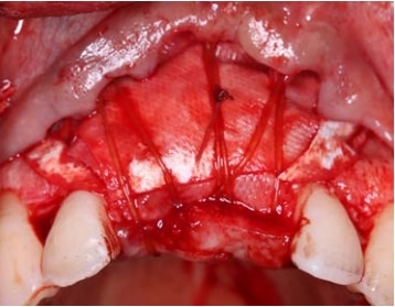 Collagen membrane placement