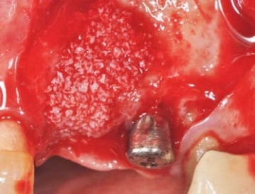InterOss® placement