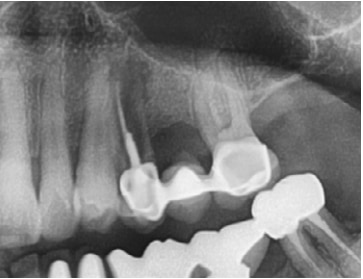 Pre-operative X-ray
